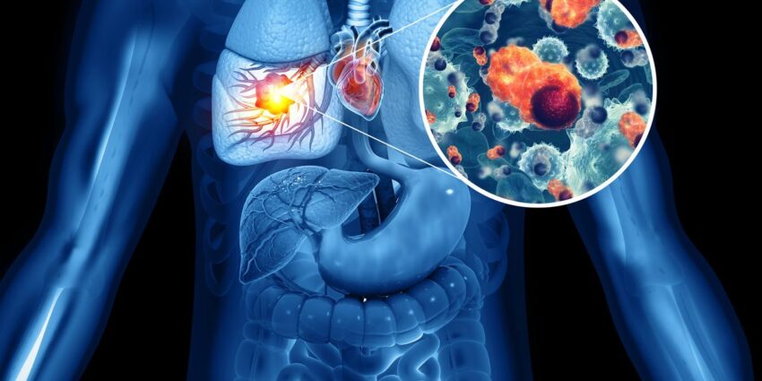 Combination Therapy Extends Survival for Advanced-Stage Colon Cancer Patients: New Study
